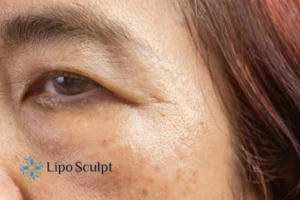 Are age spots Great Barr giving you low self esteem? Contact us today!